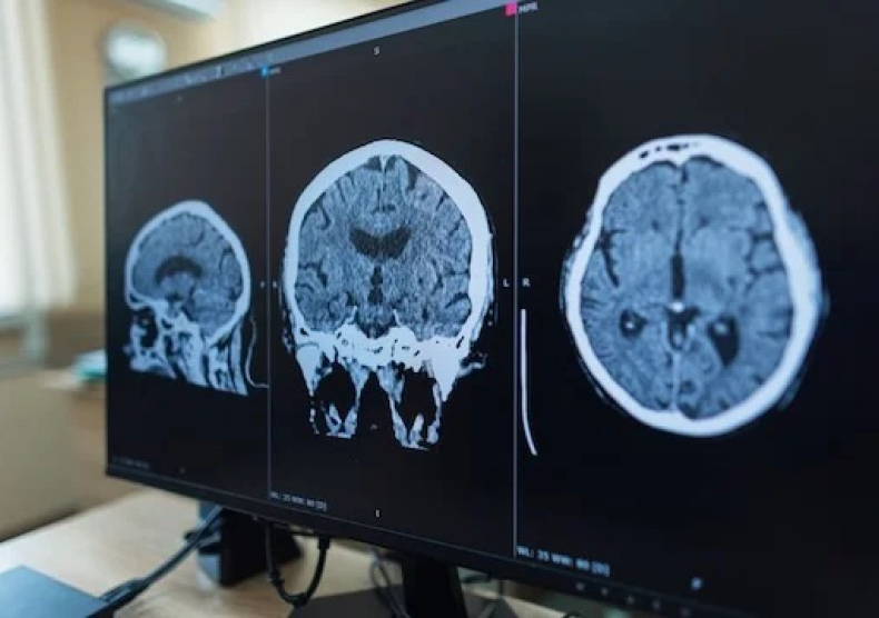 Three medical brain scans displayed on a monitor